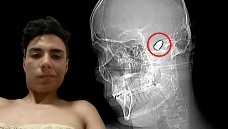 Kafasında Patlamaya Hazır Bomba ile Hayata Tutunmaya Çalışan Genç